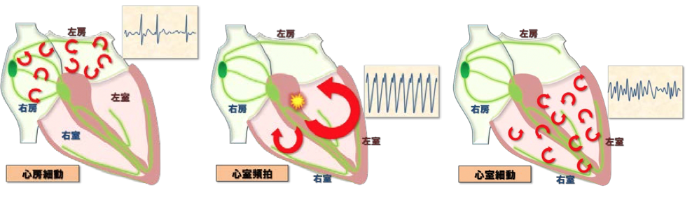 肥大型心筋症に合併する不整脈 (心房細動・心室頻拍・心室細動)