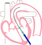 心臓の先端から挿入